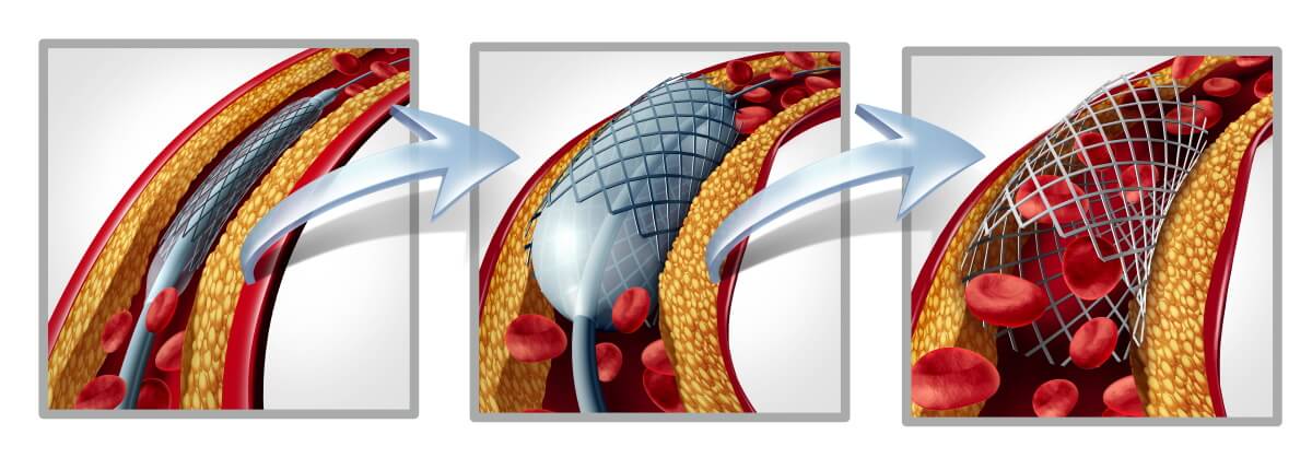 Herzinfarktbehandlung: Stent wird eingesetzt.