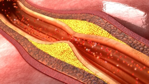 Ablagerungen in Arterie