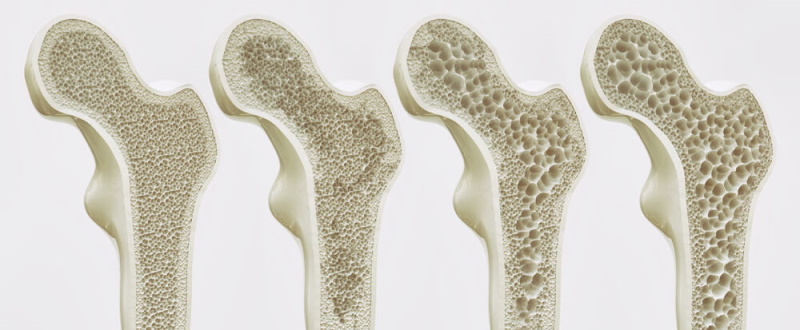 Veränderung des Knochens bei Osteoporose