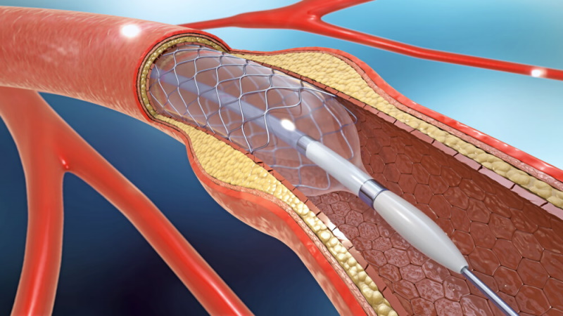 3D Stent hält Gefäß offen