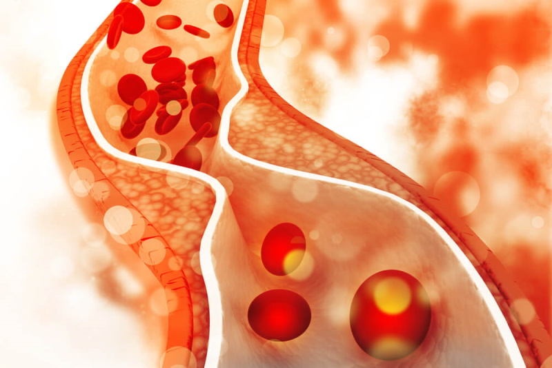 Verengtes Blutgefäß Arteriosklerose